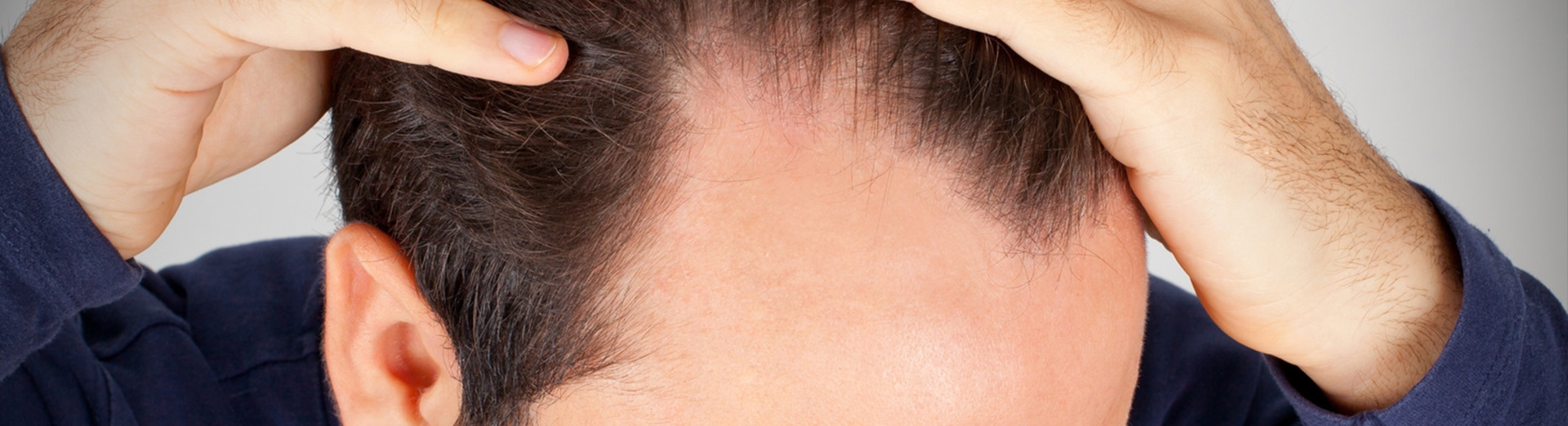 Андрогенная алопеция